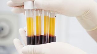 Salud: El plasma puede ser beneficioso pero no curar