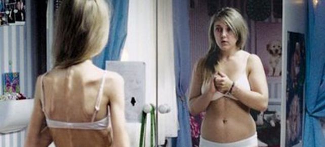 Severas multas en Francia para quienes inciten a la anorexia