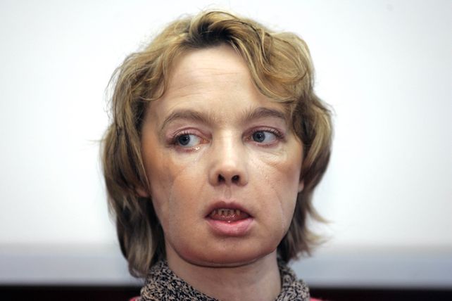 Isabelle Dinoire. La francesa de 49 años murió tras una larga enfermedad.&nbsp;