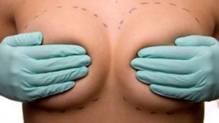 &iquest;Cada cu&aacute;nto hay que cambiarse los implantes de silicona?