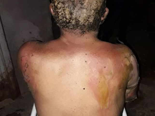 El hombre&nbsp;sufrió graves quemaduras en el pecho y espalda.