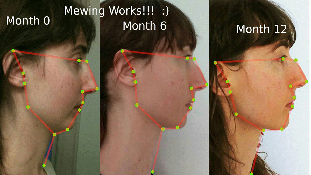 De qué se trata el mewing, la técnica viral para modelar el rostro