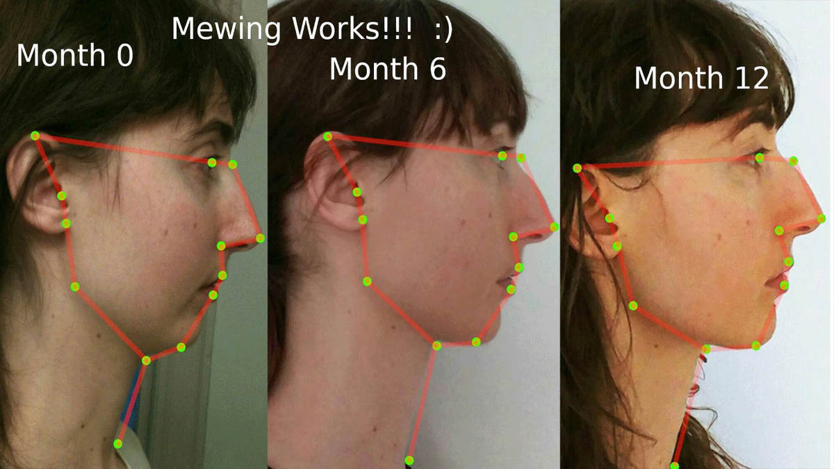 RETOQUE ESTÉTICO VIRAL  Apúntate al Mewing: la técnica viral para  modificar la mandíbula de la que todo el mundo habla