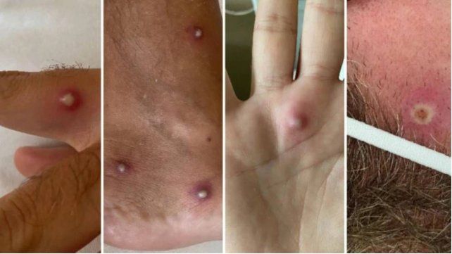 Emergencia global por la viruela símica: cuántos casos hay en Argentina