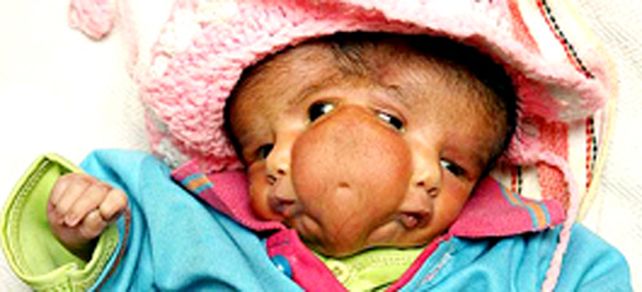 Una beba con dos caras es adorada en la India
