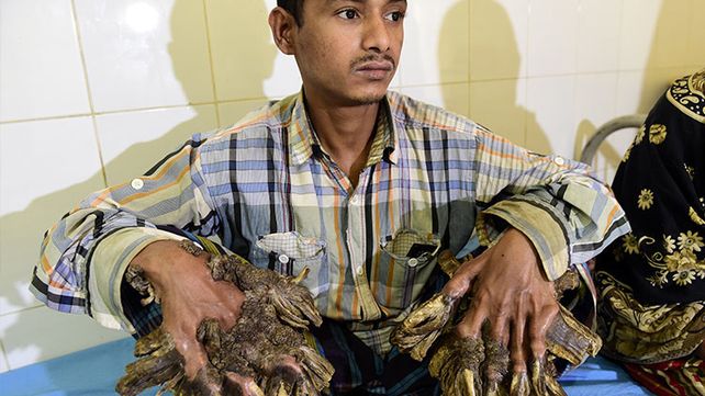 El hombre árbol de Bangladés por fin pudo abrazar a su hija