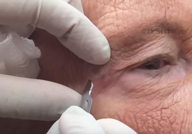 No apto para impresionables: le sacan un gigantesco punto negro de la cara