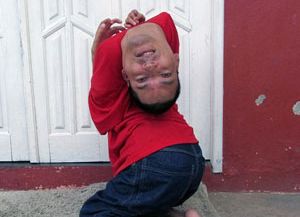 La sorprendente historia de superación de un hombre que nació con la cabeza al revés