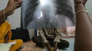 Aumentaron un 38% los casos de tuberculosis en el país