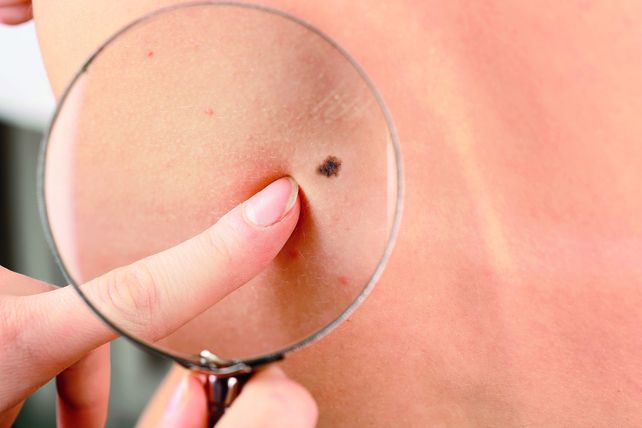 ¿Cómo identificar los lunares peligrosos?