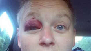 Aplastó su rostro contra una torta de cumpleaños y casi pierde un ojo