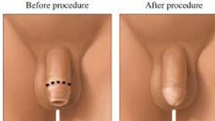 La circuncisi&oacute;n reduce el contagio de enfermedades como el sida