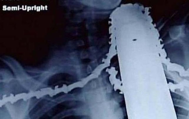 Rompió cadena. La radiografía que le tomaron al paciente es testimonio elocuente del milagro.