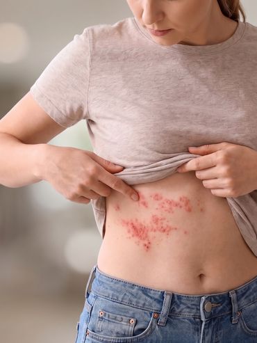 Culebrilla: por qué el virus de la varicela puede despertar décadas después