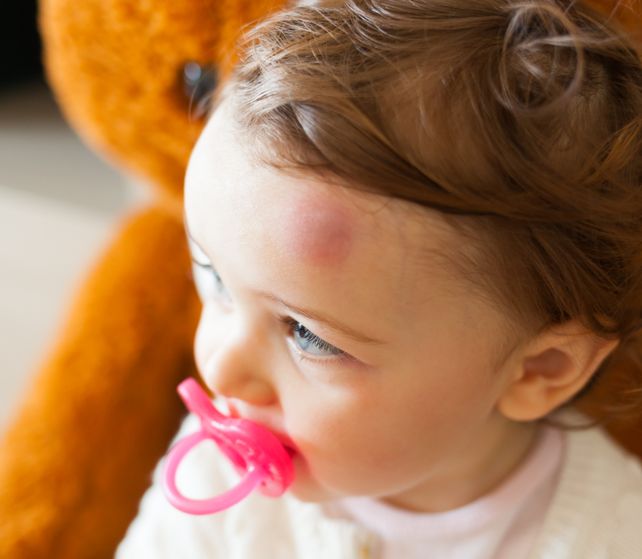 Golpes en la cabeza en la infancia: cómo actuar y cuándo consultar al médico