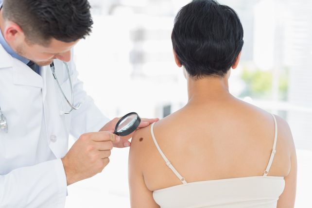 Cáncer de piel: advierten que el control de los lunares no debe esperar