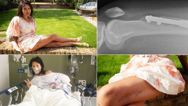 El alargamiento de piernas es un procedimiento poco común. Elaine Foo se sometió a esta operación en Londres. La dismorfia corporal y sus consecuencias&nbsp; 