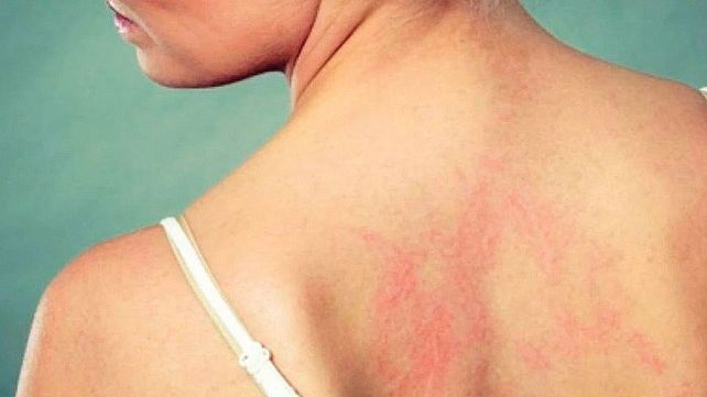 Nuevo síndrome relacionado al Coronavirus Covid-19
