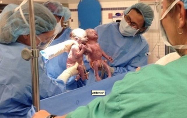 El momento en que salieron del vientre materno tomadas de la mano quedó registrado por las cámaras.