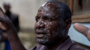 El brote y el 96% de los casos y muertes de este tipo de viruela se han producido en el Congo.