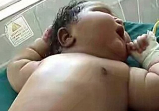 El bebé más grande del mundo nació en la India con 7 kilos de peso y por cesárea