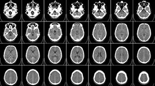Alzheimer: Identificaron perfiles característicos de la progresión de esta enfermedad