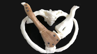 Hacen prótesis de cadera a medida  con impresoras 3D