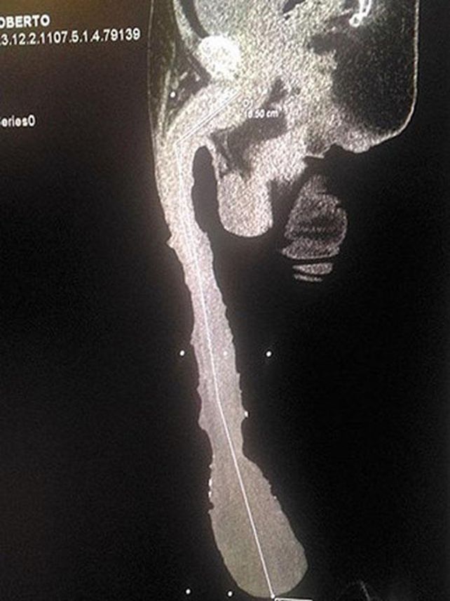 Imagen médica que muestra el descomunal tamaño del miembro del mexicano.
