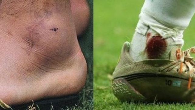 Secuela. La imagen de cómo quedó el tobillo izquierdo de Maradona en el 90 y el de Messi tras el golpe de Fabra.