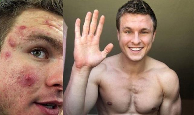 Es furor en Instagram: contó como venció al acné