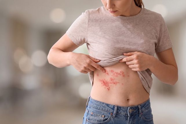 Culebrilla: por qué el virus de la varicela puede despertar décadas después