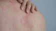 Lanzan campaña nacional gratuita para detectar la psoriasis