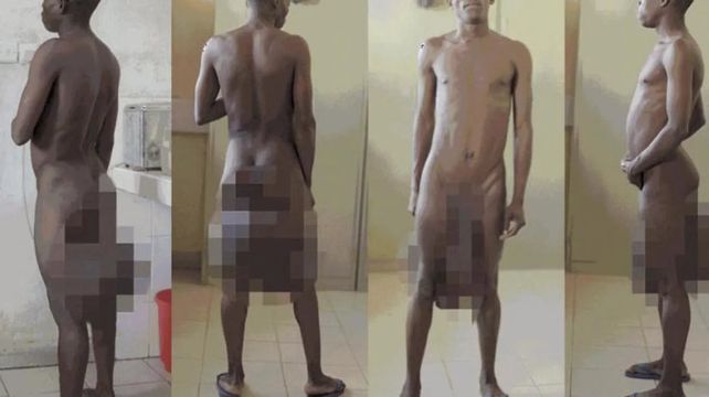 Operaron al hombre que tenía un metro de pene y cinco kilos de testículos