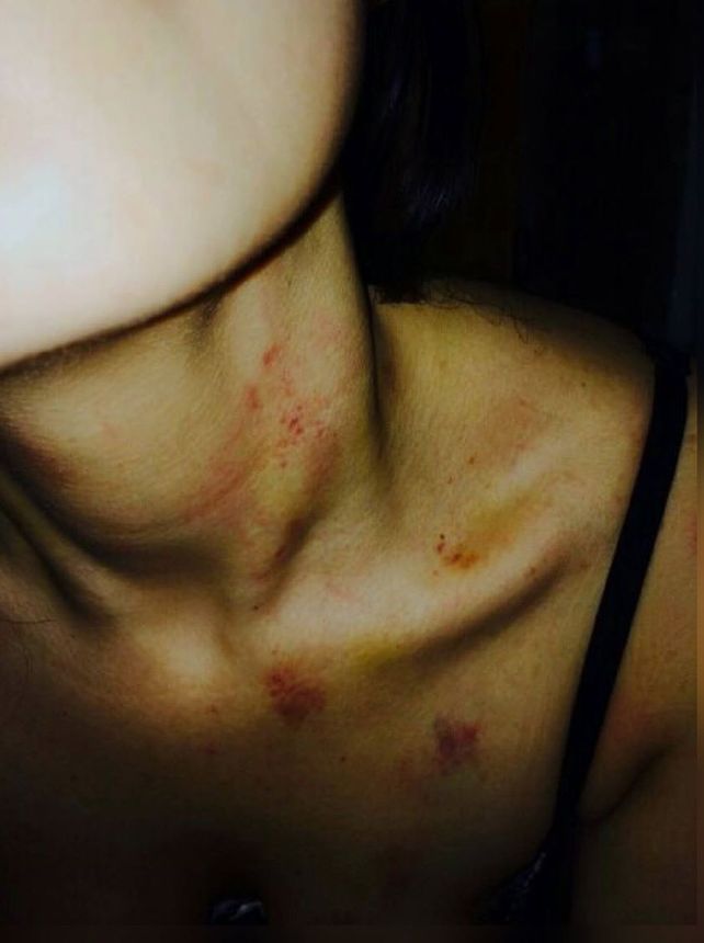 La joven mostró las marcas que le quedaron después de la agresión.&nbsp;