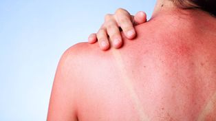 Ola de calor: remedios buenos y baratos para remediar el exceso de sol