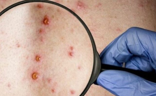 Viruela del mono: expertos deciden si se declara el nivel de alerta máxima