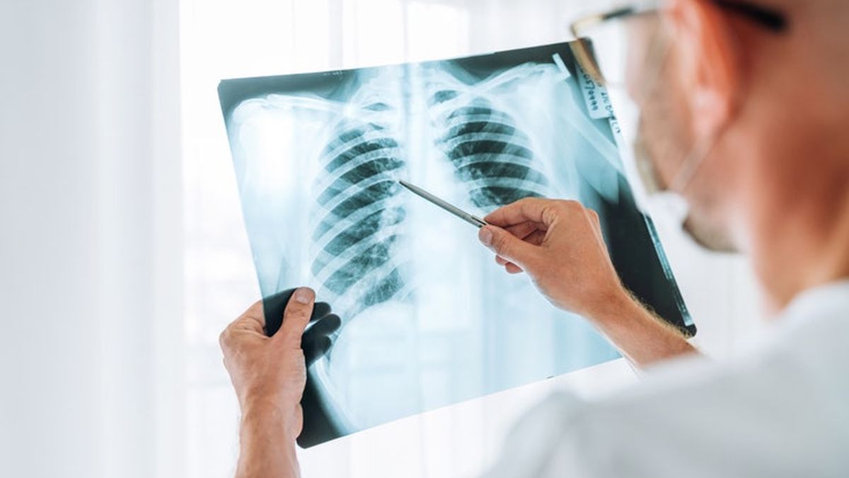 Nódulo pulmonar: lo que tiene el Papa es un hallazgo frecuente en Santa Fe