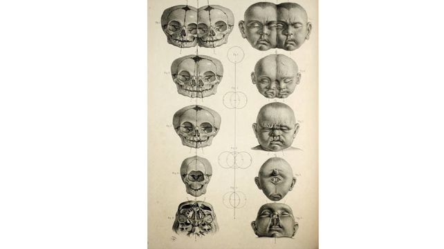La extraña historia de Edward Mordrake, el hombre de dos caras