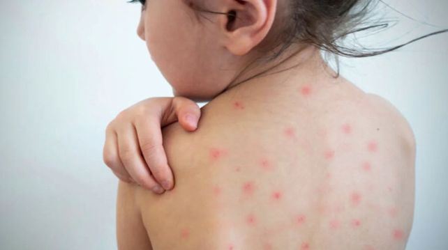 Con el aislamiento bajaron las enfermedades respiratorias y no hubo nuevos casos de sarampión