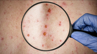 En el país hay 24 casos confirmados de contagios con el virus de la viruela del mono,&nbsp;
