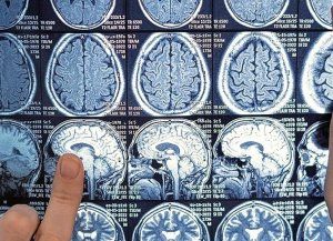 Esclerosis múltiple: identifican proteínas novedosas implicadas en la neurodegeneración