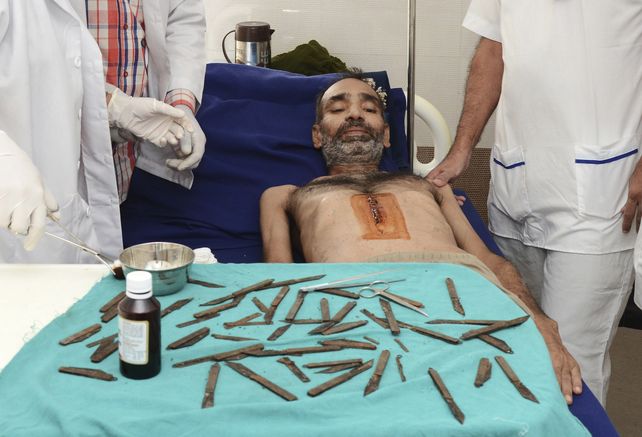 Fue al médico por un fuerte dolor abdominal y lo operaron para sacarle 40 navajas de la panza