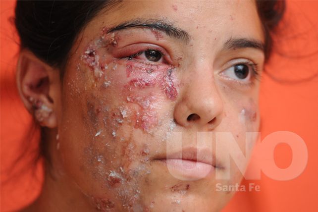 Hablaron las víctimas de las dos bombas en barrio Liceo Norte