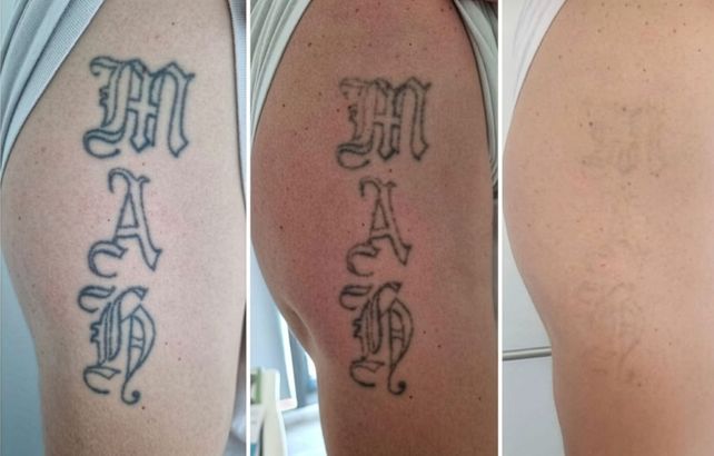 Mucho más que estética: cómo borrar tatuajes, y el ranking de los arrepentidos