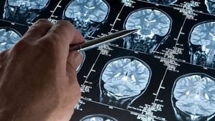 Descubren cómo detectar a tiempo el inicio del Alzheimer con un simple test de sangre