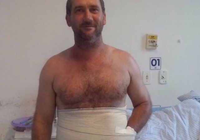 Le abrieron un bolsillo en el abdomen para salvarle la mano