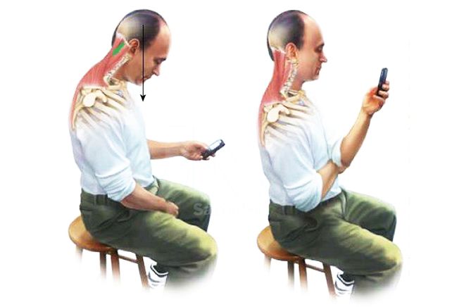Los dispositivos móviles y los problemas cervicales severos