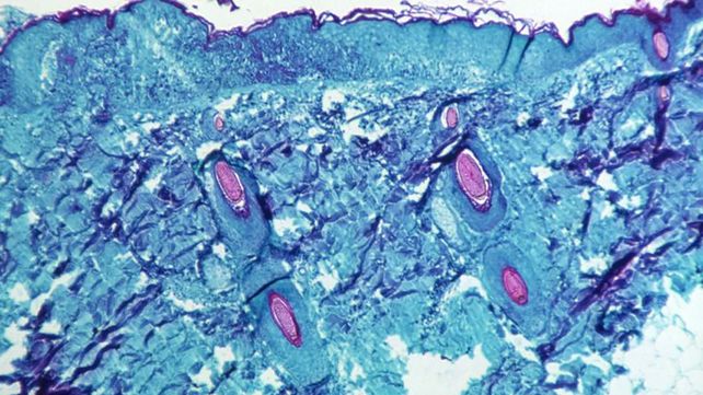 Descubren cuál es el mecanismo que usa el virus de la viruela del mono. Qué implica para el control de la infección que ya tiene más de 23.000 casos en el mundo