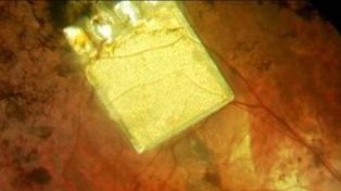 Pacientes logran recobrar la visión con implantes de chips