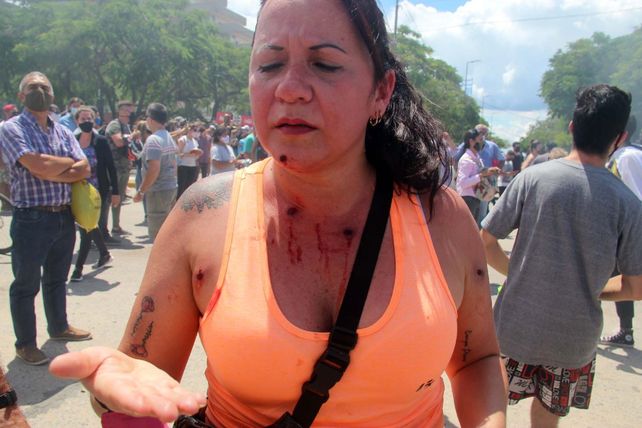 A LOS TIROS. Una mujer muestra las marcas que las balas de goma policiales dejaron sobre su cuerpo.